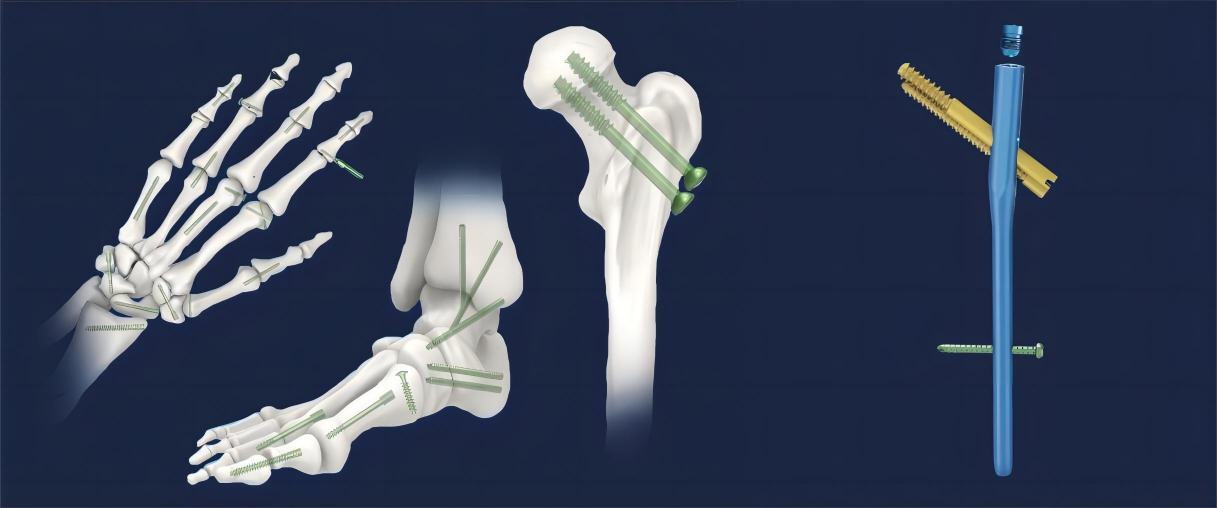 Metastastic Bone Carcinoma: Prophylactic Femoral IM Nailing : Wheeless'  Textbook of Orthopaedics